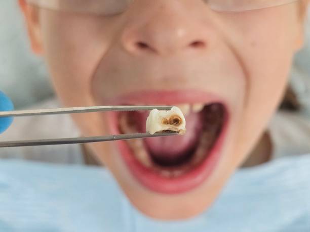 Best Emergency Dental Care for Broken or Chipped Teeth in Jacksonville Beach, FL